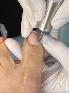 Maschinelle Fußpflege-Ausbildung: Nagelbearbeitung am Zehennagel mit dem Fräser, Hände mit Schutzhandschuhen